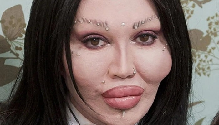 Pete Burns' Looks Like Disaster After Failed Plastic Surgeries